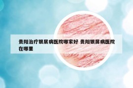 貴陽(yáng)治療銀屑病醫(yī)院哪家好 貴陽(yáng)銀屑病醫(yī)院在哪里