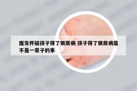 醫(yī)生懷疑孩子得了銀屑病 孩子得了銀屑病是不是一輩子的事
