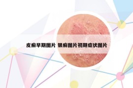 皮癬早期圖片 銀癬圖片初期癥狀圖片