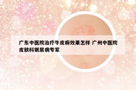 廣東中醫(yī)院治療牛皮癬效果怎樣 廣州中醫(yī)院皮膚科銀屑病專家