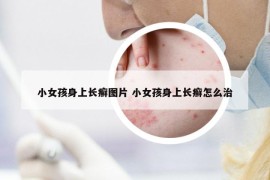 小女孩身上長癬圖片 小女孩身上長癬怎么治