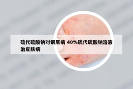 硫代硫酸鈉對(duì)銀屑病 40%硫代硫酸鈉溶液治皮膚病