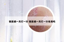 銀屑病一月打一針 銀屑病一月打一針有用嗎