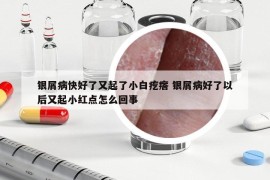 銀屑病快好了又起了小白疙瘩 銀屑病好了以后又起小紅點(diǎn)怎么回事