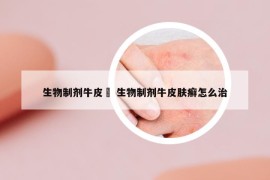 生物制劑牛皮廯 生物制劑牛皮膚癬怎么治