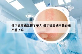 得了銀屑病又得了甲亢 得了銀屑病甲是說明嚴(yán)重了嗎