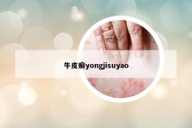 牛皮癬yongjisuyao