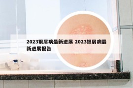 2023銀屑病最新進(jìn)展 2023銀屑病最新進(jìn)展報告