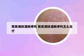銀屑病抹酒精疼嗎 銀屑病抹酒精疼嗎怎么治療