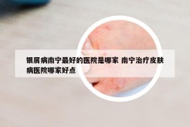 銀屑病南寧最好的醫(yī)院是哪家 南寧治療皮膚病醫(yī)院哪家好點