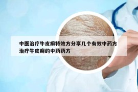 中醫(yī)治療牛皮癬特效方分享幾個(gè)有效中藥方 治療牛皮癬的中藥藥方