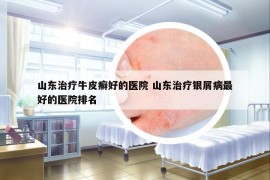 山東治療牛皮癬好的醫(yī)院 山東治療銀屑病最好的醫(yī)院排名
