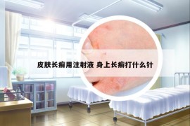 皮膚長癬用注射液 身上長癬打什么針