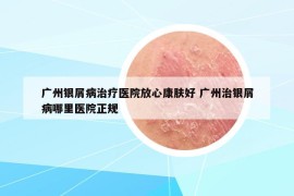 廣州銀屑病治療醫(yī)院放心康膚好 廣州治銀屑病哪里醫(yī)院正規(guī)