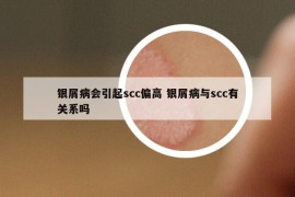 銀屑病會引起scc偏高 銀屑病與scc有關(guān)系嗎