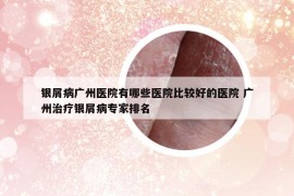 銀屑病廣州醫(yī)院有哪些醫(yī)院比較好的醫(yī)院 廣州治療銀屑病專家排名