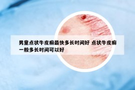 男童點(diǎn)狀牛皮癬最快多長時間好 點(diǎn)狀牛皮癬一般多長時間可以好