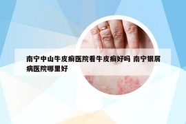 南寧中山牛皮癬醫(yī)院看牛皮癬好嗎 南寧銀屑病醫(yī)院哪里好