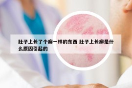 肚子上長了個癬一樣的東西 肚子上長癬是什么原因引起的