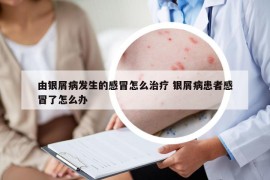 由銀屑病發(fā)生的感冒怎么治療 銀屑病患者感冒了怎么辦