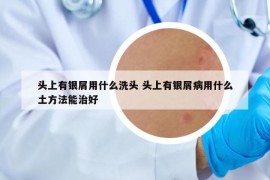 頭上有銀屑用什么洗頭 頭上有銀屑病用什么土方法能治好