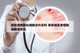 銀屑病嗜酸粒細胞會升高嗎 銀屑病患者嗜酸細胞增高嗎