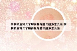 前胸和后背長了癬而且癢越長越多怎么治 前胸和后背長了癬而且癢越長越多怎么治