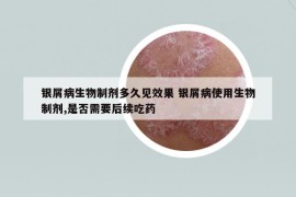 銀屑病生物制劑多久見效果 銀屑病使用生物制劑,是否需要后續(xù)吃藥