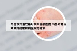 烏魯木齊治效果好的銀屑病醫(yī)院 烏魯木齊治效果好的銀屑病醫(yī)院是哪家