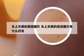 頭上長癬的原因圖片 頭上長癬的癥狀圖片用什么藥膏