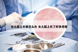女兒腿上長(zhǎng)癬怎么辦 女兒腿上長(zhǎng)了好多疙瘩