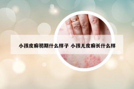 小孩皮癬初期什么樣子 小孩兒皮癬長什么樣
