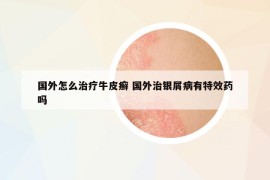 國外怎么治療牛皮癬 國外治銀屑病有特效藥嗎