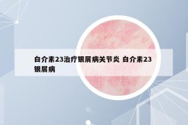 白介素23治療銀屑病關(guān)節(jié)炎 白介素23 銀屑病