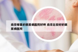 南京哪里的銀屑病醫(yī)院好啊 南京比較好的銀屑病醫(yī)院
