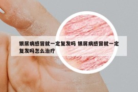 銀屑病感冒就一定復(fù)發(fā)嗎 銀屑病感冒就一定復(fù)發(fā)嗎怎么治療
