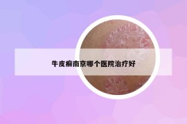 牛皮癬南京哪個醫(yī)院治療好
