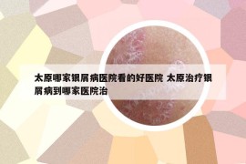 太原哪家銀屑病醫(yī)院看的好醫(yī)院 太原治療銀屑病到哪家醫(yī)院治