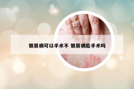 銀屑病可以手術(shù)不 銀屑病能手術(shù)嗎