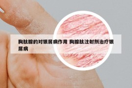 胸肽腺的對(duì)銀屑病作用 胸腺肽注射劑治療銀屑病