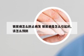 銀屑病怎么防止病發(fā) 銀屑病是怎么引起的,該怎么預防