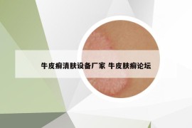 牛皮癬清膚設(shè)備廠家 牛皮膚癬論壇