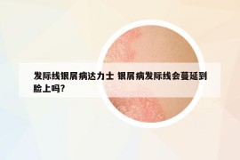 發(fā)際線銀屑病達(dá)力士 銀屑病發(fā)際線會(huì)蔓延到臉上嗎?