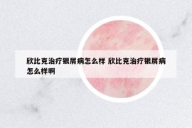 欣比克治療銀屑病怎么樣 欣比克治療銀屑病怎么樣啊