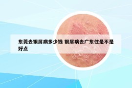 東莞去銀屑病多少錢 銀屑病去廣東住是不是好點