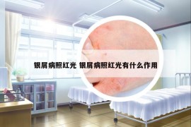 銀屑病照紅光 銀屑病照紅光有什么作用