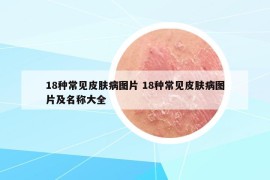 18種常見皮膚病圖片 18種常見皮膚病圖片及名稱大全