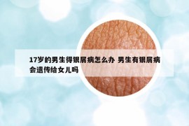 17歲的男生得銀屑病怎么辦 男生有銀屑病會遺傳給女兒嗎