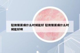輕微銀屑病什么時候能好 輕微銀屑病什么時候能好啊