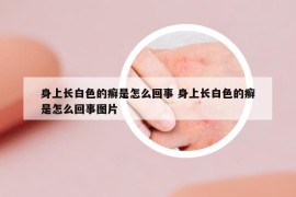 身上長白色的癬是怎么回事 身上長白色的癬是怎么回事圖片